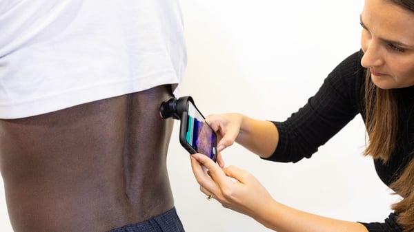 AI software to detect skin cancer rolled out in West Yorkshire